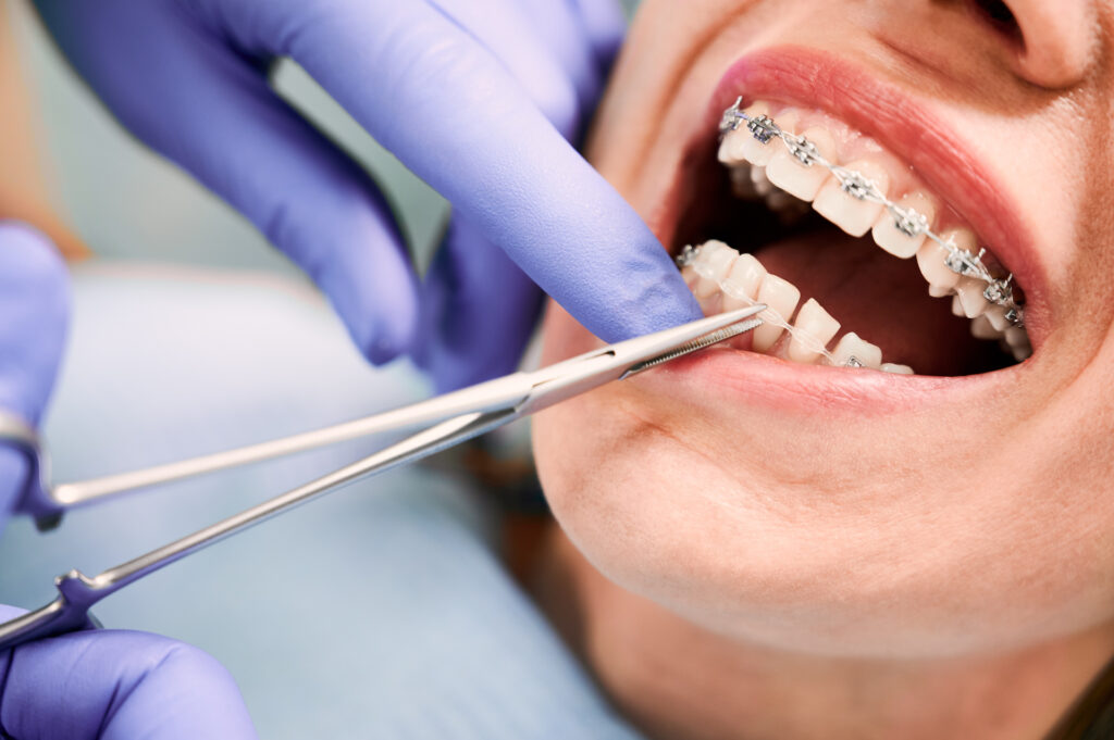 How Long Does Treatment With Braces Last