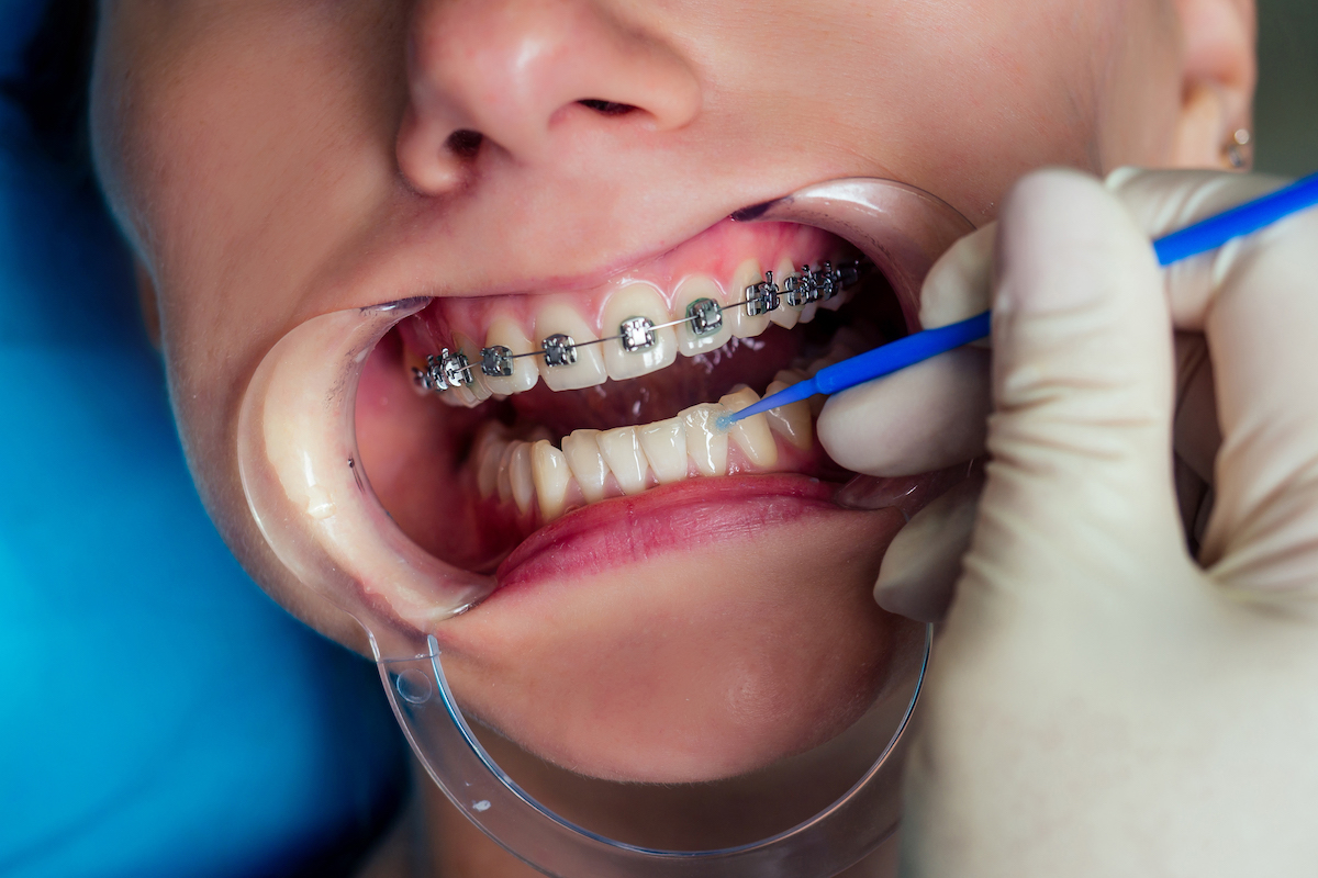 How Long Does Treatment with Clear Braces Normally Take?