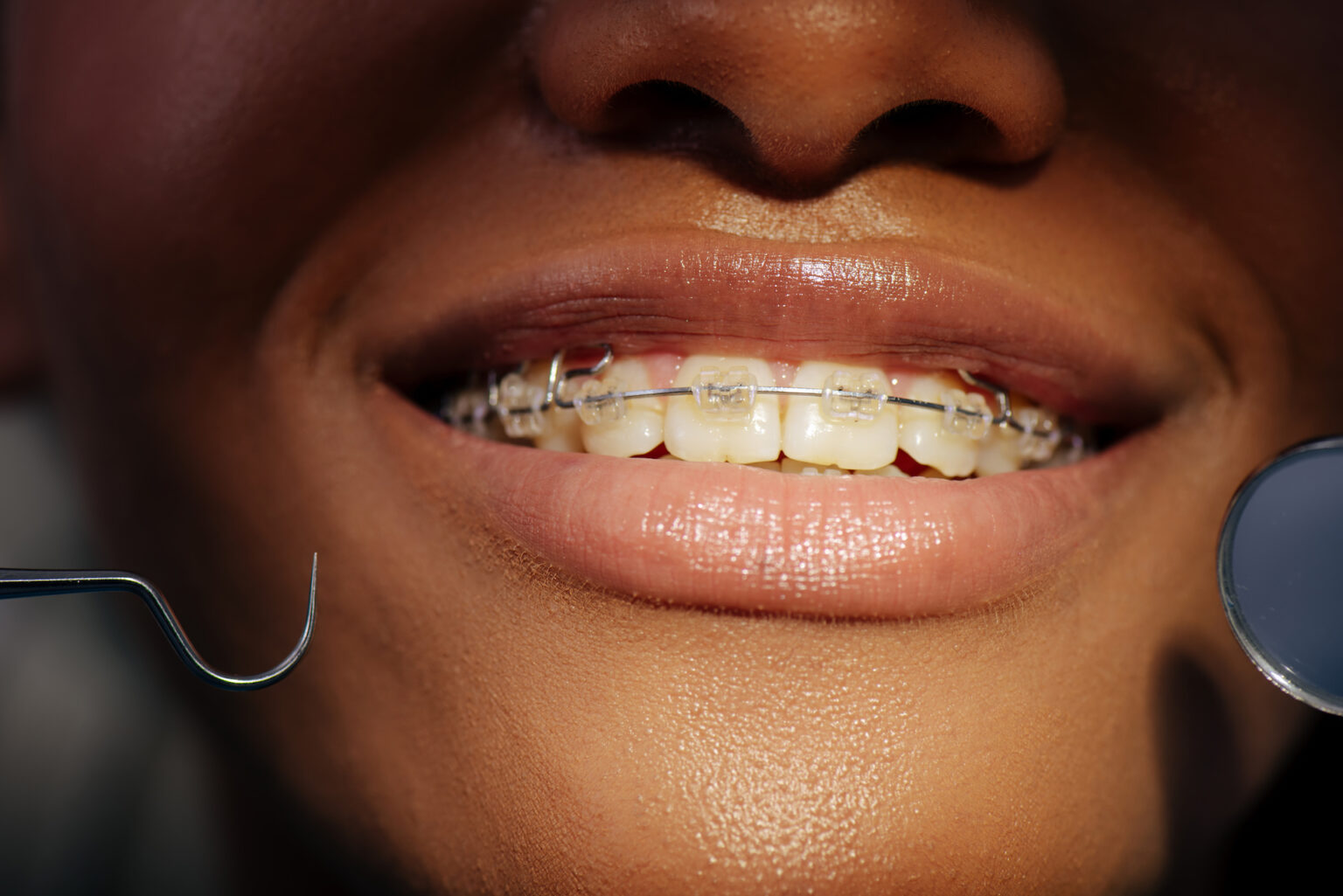 How to Relieve Pain From Braces Risas Dental and Braces